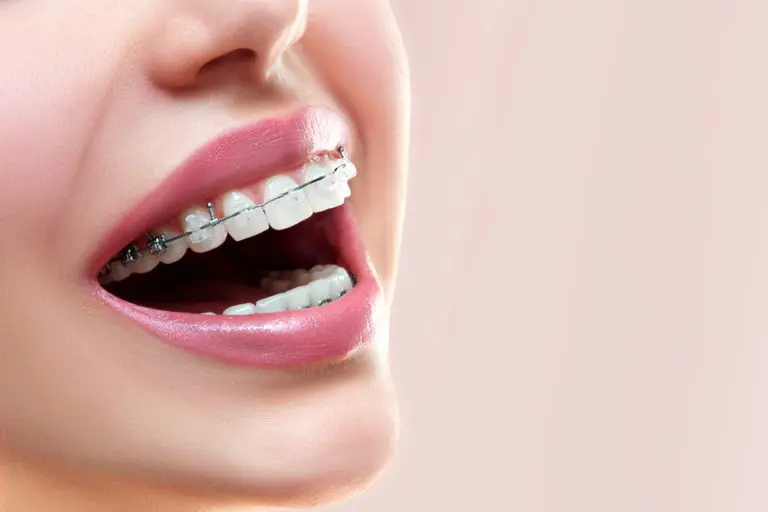A close-up shows a smiling person's mouth with ceramic and metal braces, highlighting Invisalign as an alternative—featuring treatment options available at Andros Orthodontics in Pasco, WA—all set against a light pink background.