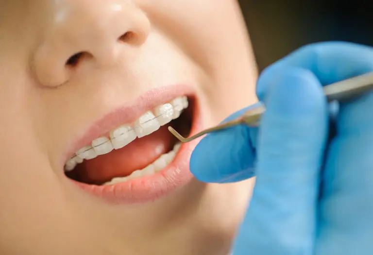 A dentist in blue gloves uses a dental tool to examine the teeth of a patient with Clarity Advanced Braces at Andros Orthodontics in Pasco, WA.