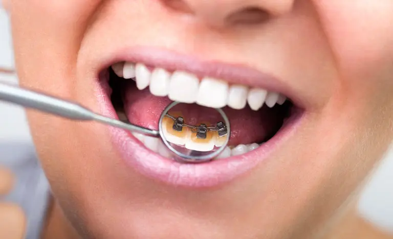 A close-up reveals discreet lingual braces attached to the back of the teeth, shown with a dental mirror at Andros Orthodontics in Pasco, WA.