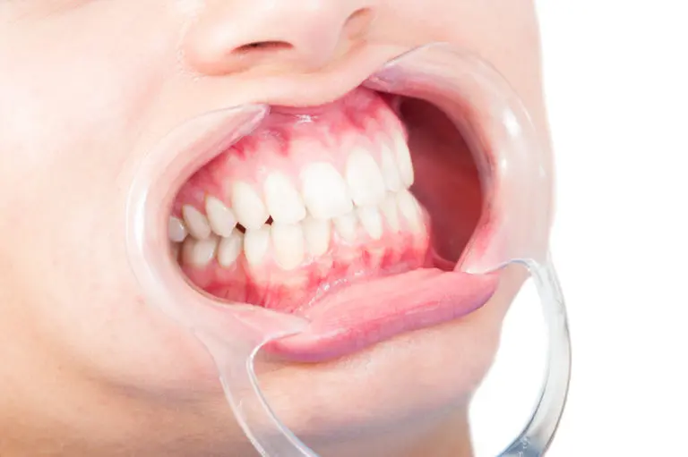 A dental cheek retractor is used during exams or treatments at Andros Orthodontics in Pasco, WA to expose teeth and gums for bite assessments.