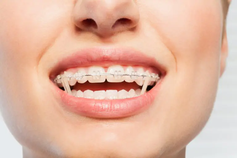 A close-up shows clear braces with rubber bands connecting the upper and lower brackets on a patient's teeth at Andros Orthodontics in Pasco, WA.