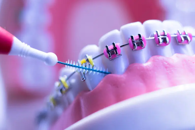 This close-up image at Andros Orthodontics in Pasco, WA highlights proper tooth care and cleaning with braces, showing an interdental brush used between wires and brackets.