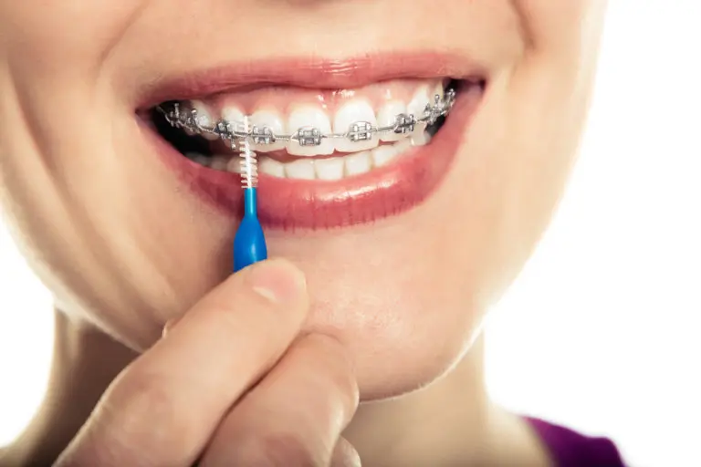 Patients at Andros Orthodontics in Pasco, WA maintain oral hygiene by using an interdental brush to clean between braces brackets.