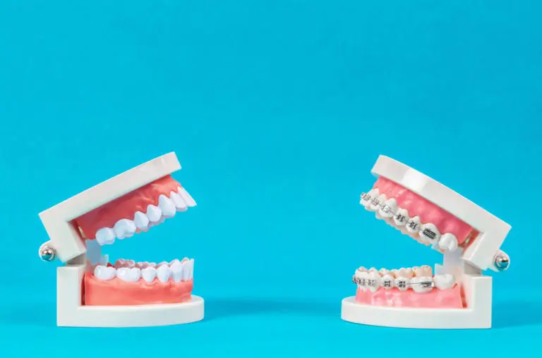 On a blue background, two dental models—one with straight teeth and one with metal braces—illustrate the transformation and cost of braces provided by Andros Orthodontics in Pasco, WA.