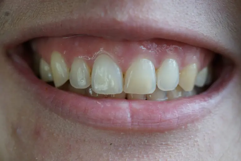 A close-up of a smiling mouth reveals a noticeable chip on an upper front tooth at Andros Orthodontics in Pasco, WA.