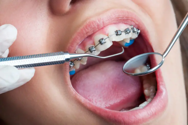 A detailed view during a dental exam at Andros Orthodontics in Pasco, WA, shows braces and dental tools inspecting teeth and gums.