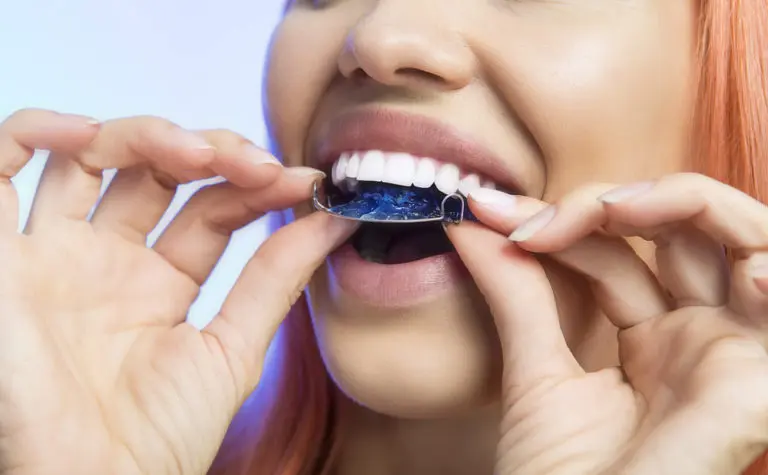 At Andros Orthodontics in Pasco, WA, a person uses both hands to place a dental retainer onto their upper teeth.