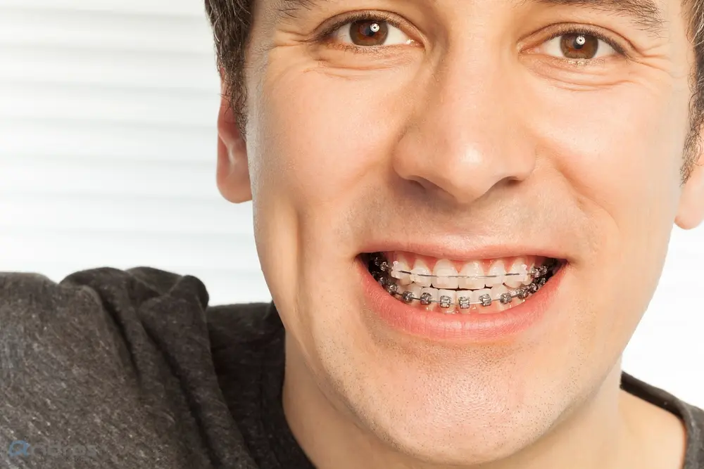 happy young man with metal braces - Overbite vs Underbite in Pasco, WA