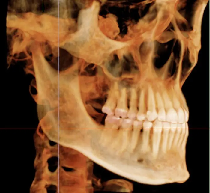 Side view of a human skull, jaw, and teeth 3D CT scan at Andros Orthodontics in Pasco, WA, showing bone and dental alignment.