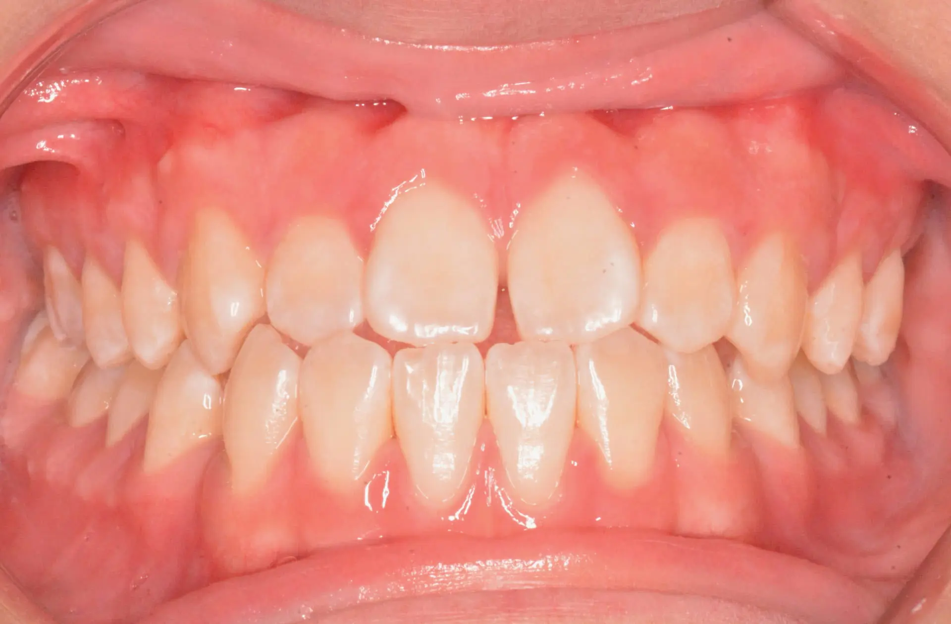 Teeth and gums with mild crowding and slight misalignment before braces at Andros Orthodontics in Pasco, WA.