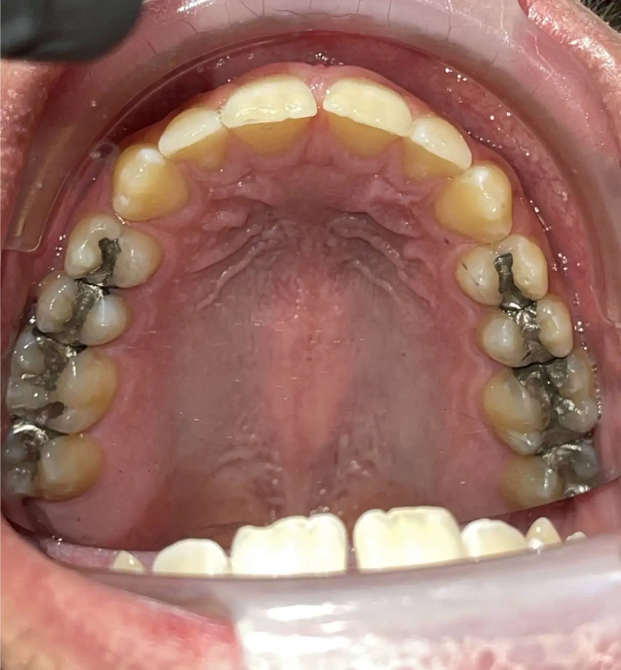 Upper teeth and palate with dental fillings in molars and healthy gums before Invisalign at Andros Orthodontics in Pasco, WA.