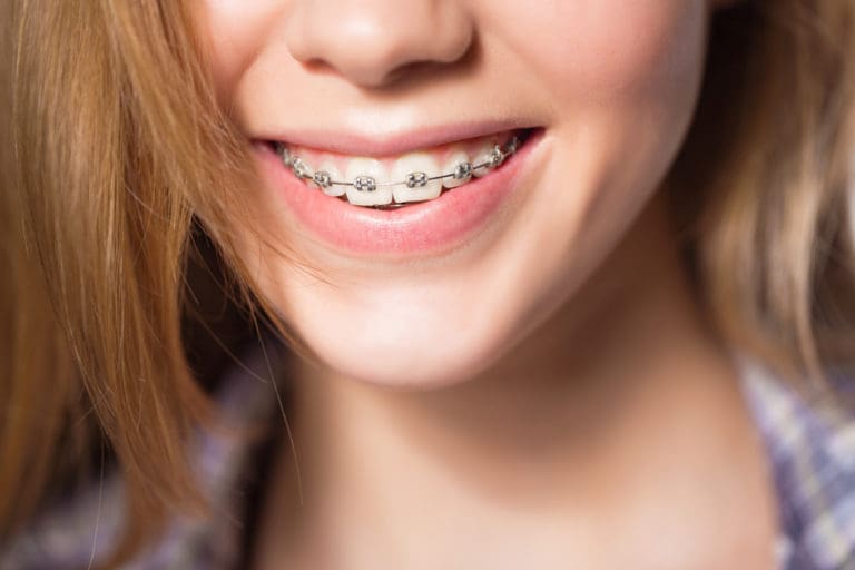 A close-up smile reveals metal braces at Andros Orthodontics in Pasco, WA.