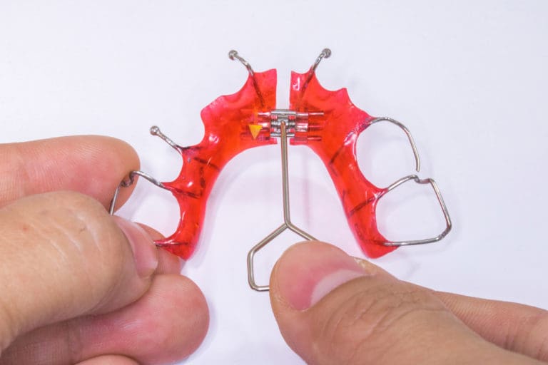 A red orthodontic retainer with metal wires and screws, resembling a palatal expander, is held in hand against a white background at Andros Orthodontics in Pasco, WA.