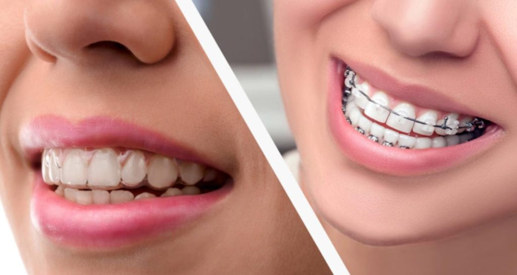 dental aligners Archives | South Shore Orthodontics