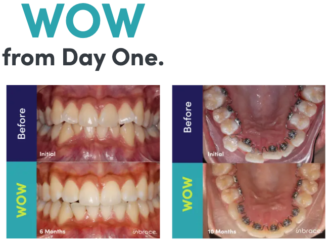 before and after from Inbrace.com