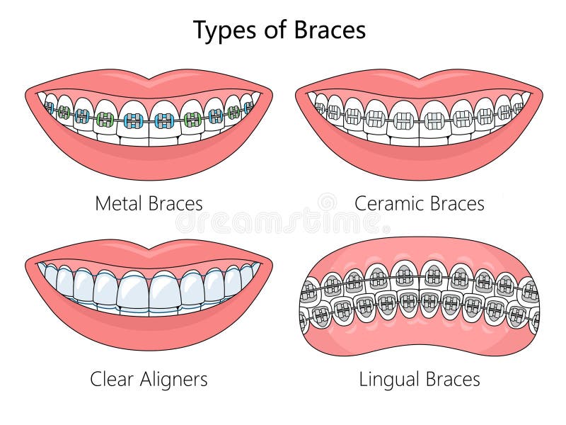 Dental Braces Stock Illustrations – 12,040 Dental Braces Stock Illustrations, Vectors & Clipart - Dreamstime
