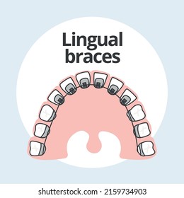 Lingual Braces: Over 382 Royalty-Free Licensable Stock ...