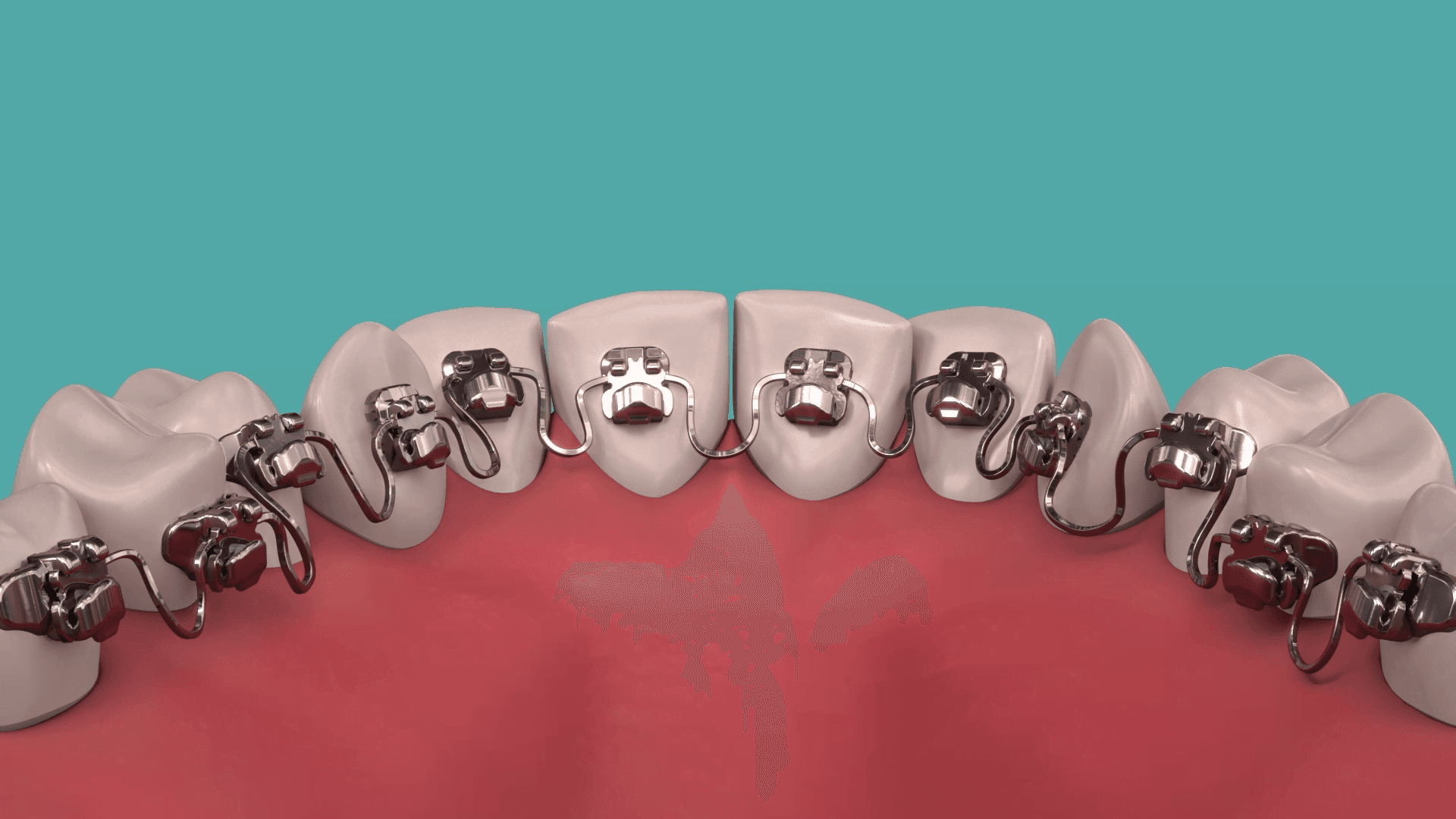 InBrace Invisible Teeth Straightener On Autopilot | Teeth Straightening