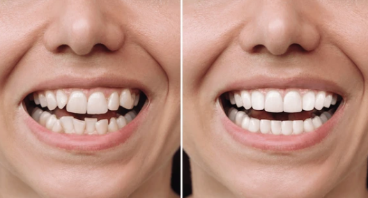 https://www.google.com/url?sa=i&url=https%3A%2F%2Fwww.shutterstock.com%2Fsearch%2Fbraces-before-after&psig=AOvVaw1k4OeCv1sOHNYdqdMN2zFU&ust=1726245048876000&source=images&cd=vfe&opi=89978449&ved=0CBcQjhxqFwoTCLCGx4nqvYgDFQAAAAAdAAAAABAE
