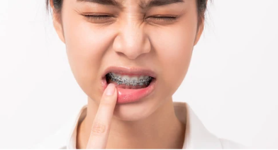 https://www.google.com/url?sa=i&url=https%3A%2F%2Fwww.shutterstock.com%2Fsearch%2Fdental-braces-pain&psig=AOvVaw099ZtEape8Zcp8YEjShD8h&ust=1726243799218000&source=images&cd=vfe&opi=89978449&ved=0CBcQjhxqFwoTCPiTtLblvYgDFQAAAAAdAAAAABAE