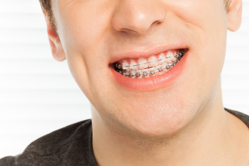 Deep Bite Correction Treatment - Andros Orthodontics | Tri Cities Orthodontics | Orthodontist Pasco & Tri Cities WA