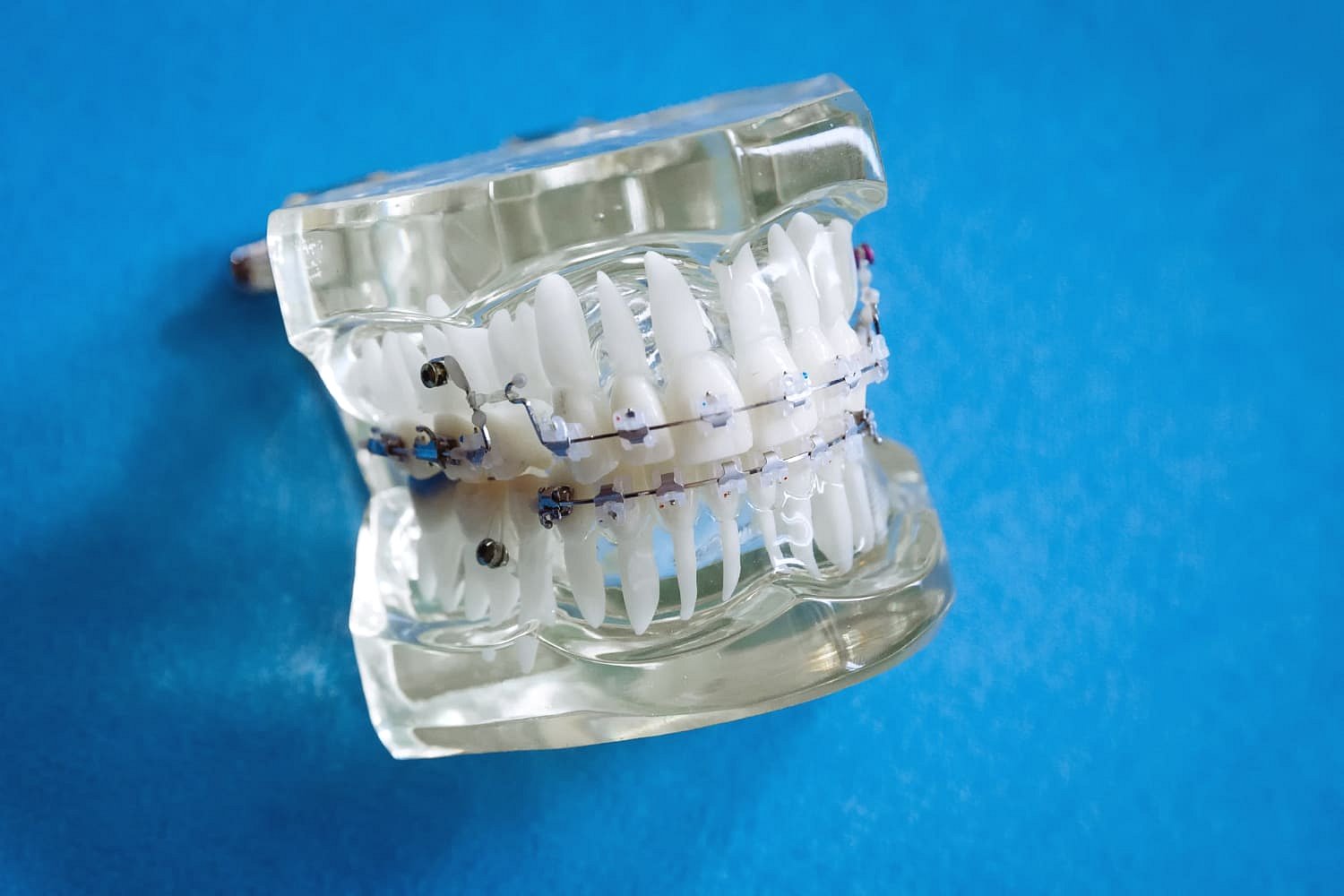 A dental model with metal braces is displayed against a blue background at Andros Orthodontics in Pasco, WA.