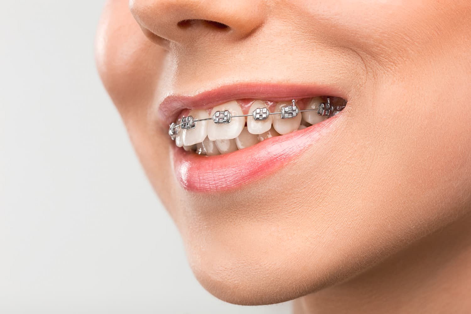 A close-up shows a person smiling with metal braces correcting an overbite, treated at Andros Orthodontics in Pasco, WA.