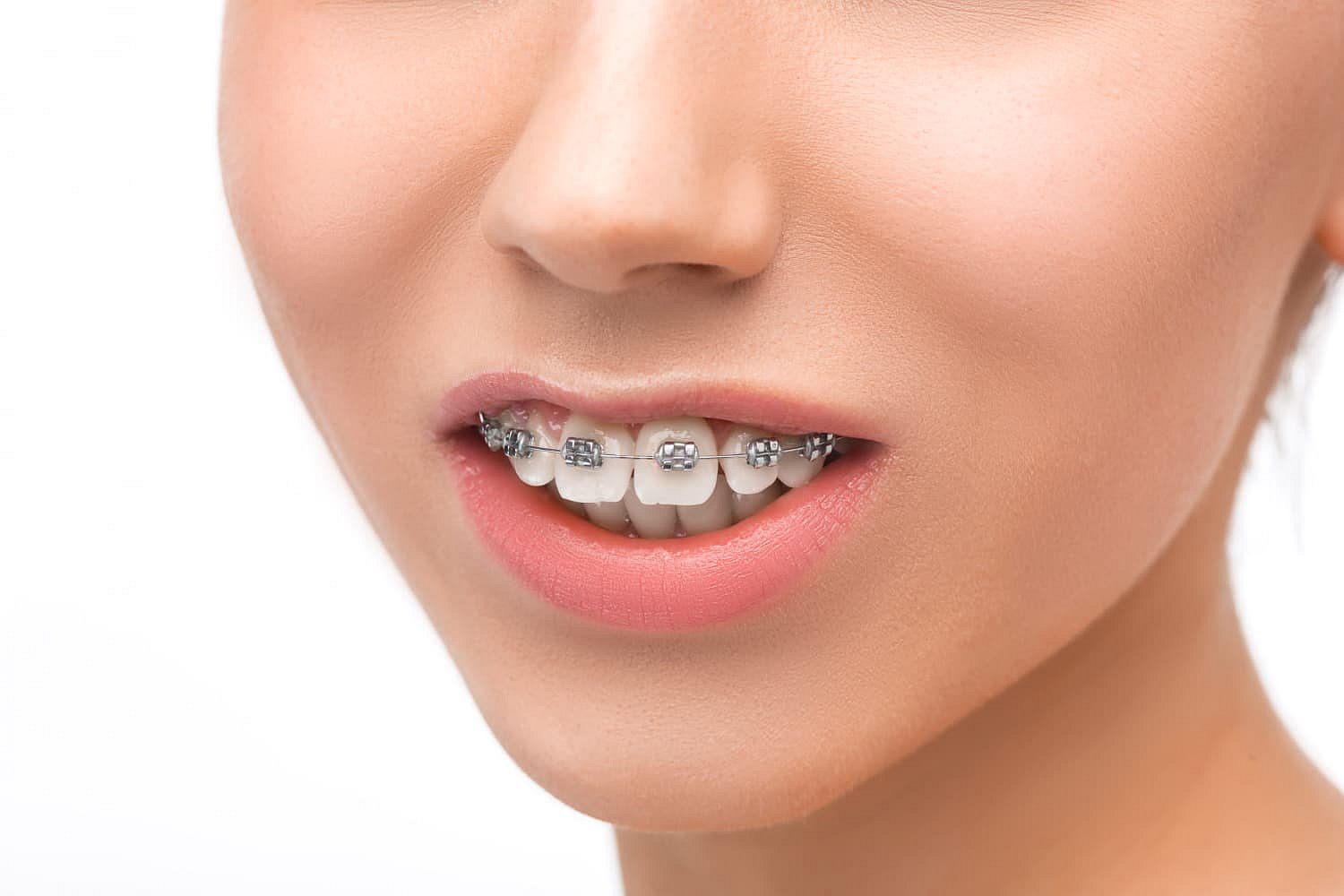A close-up highlights orthodontic treatment for an overbite at Andros Orthodontics in Pasco, WA, showing ceramic braces on the upper teeth and metal braces on the lower teeth with slightly parted lips against a white background.