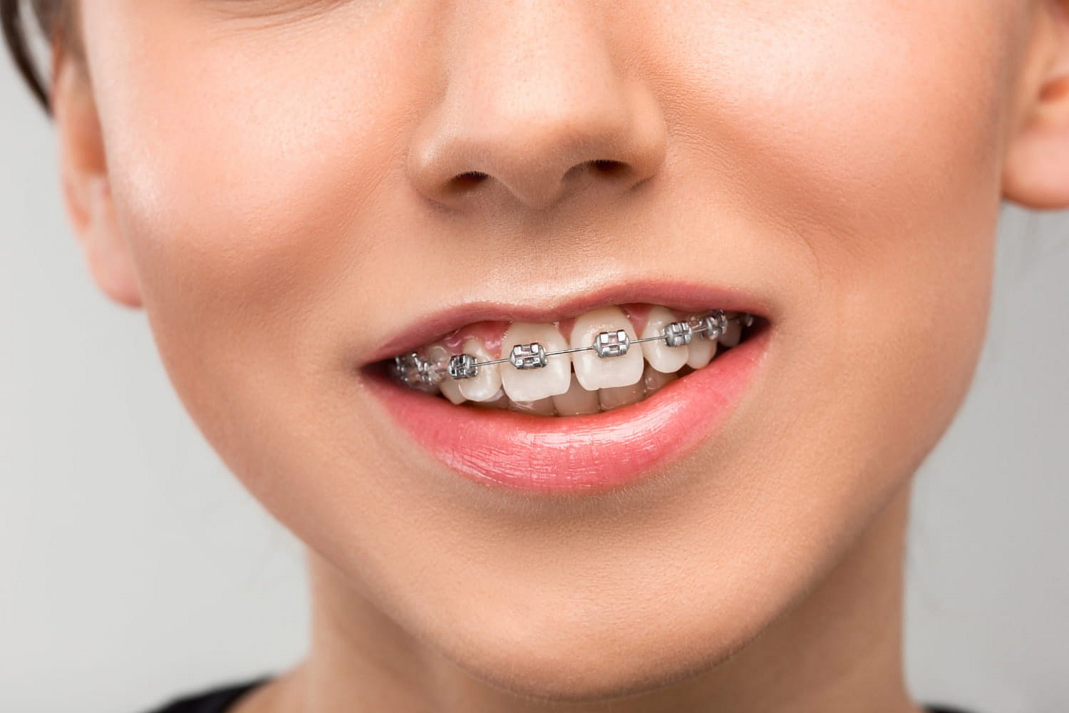 A close-up smile reveals metal braces on slightly crooked upper teeth with a visible overbite at Andros Orthodontics in Pasco, WA.