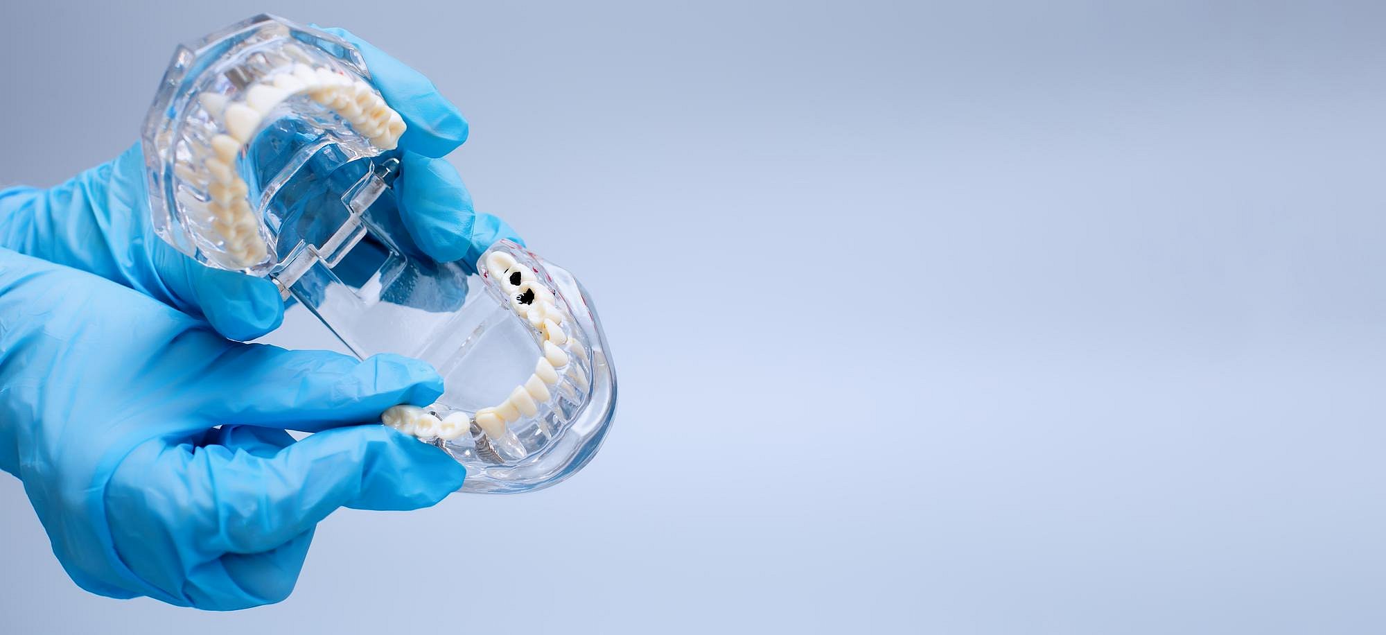 A person wearing blue gloves holds a dental model displaying teeth and implants, representing Andros Orthodontics in Pasco, WA, against a light blue background, showcasing the use of a MARPE Appliance.