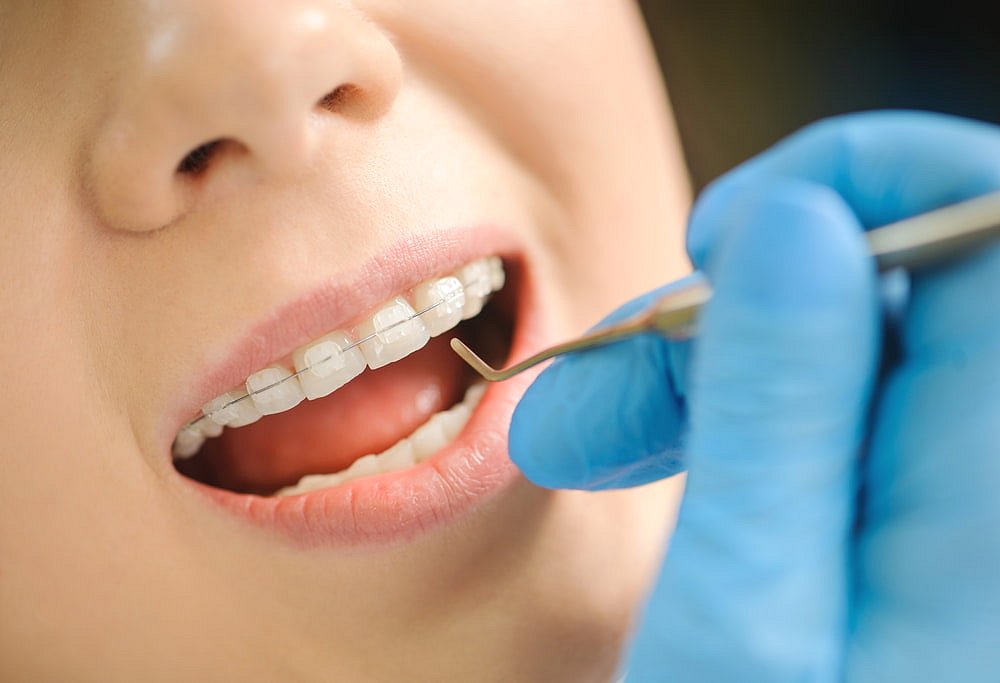 A dentist in blue gloves examines a patient with clear braces at Andros Orthodontics in Pasco, WA.