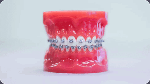 A dental model with metal braces at Andros Orthodontics in Pasco, WA displays the alignment of upper and lower teeth against a plain background.