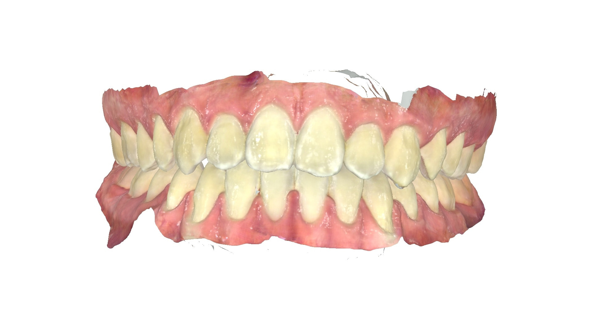 A digital 3D model displaying both upper and lower jaws from the front illustrates teeth alignment after braces at Andros Orthodontics in Pasco, WA.