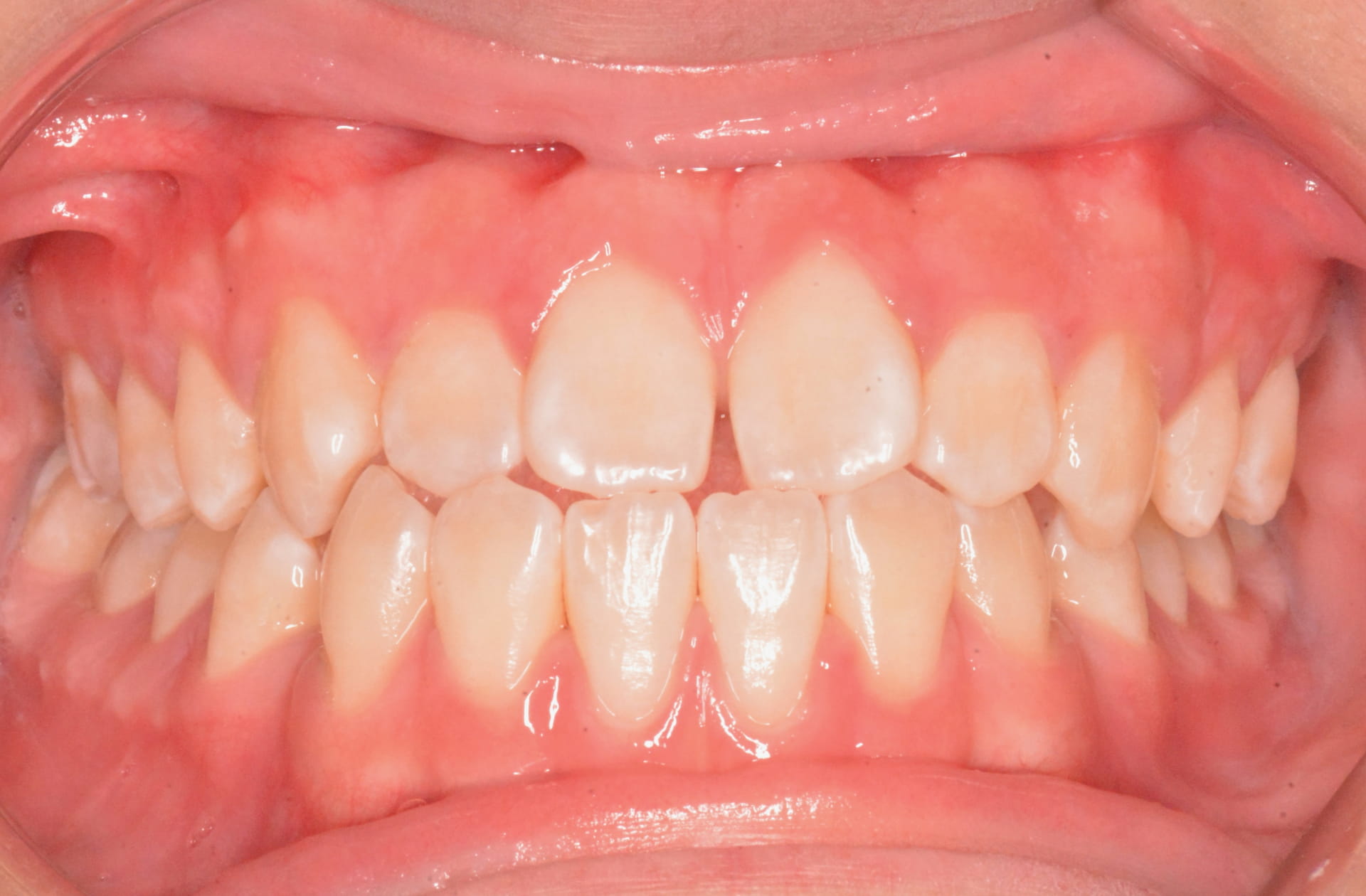 A close-up taken before braces at Andros Orthodontics in Pasco, WA shows upper and lower teeth with mild crowding and healthy pink gums.