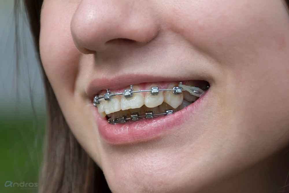A close-up shows a person smiling with metal braces and elastic bands, representing Andros Orthodontics Braces for Overbite in Pasco, WA.