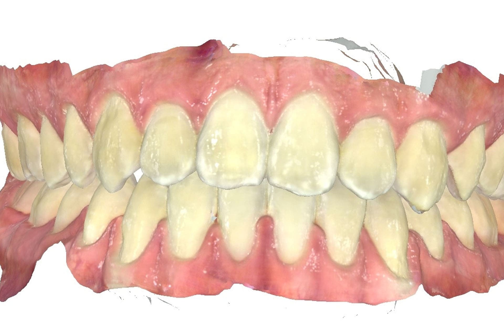 3D rendering of aligned upper and lower teeth with visible gums after braces at Andros Orthodontics in Pasco, WA.
