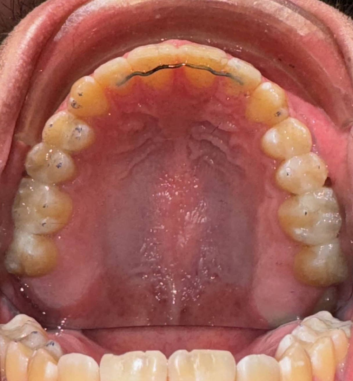 After Invisalign by Andros Orthodontics in Pasco, WA: upper teeth with a fixed retainer wire and some plaque on the molars.